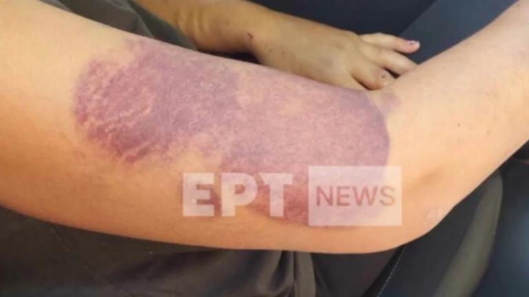 Διδυμότειχο: Σοκάρουν οι φωτογραφίες με τις μελανιές στο χέρι της 32χρονης - Ακόμη και με ξύλα την χτυπούσε ο σύντροφός της